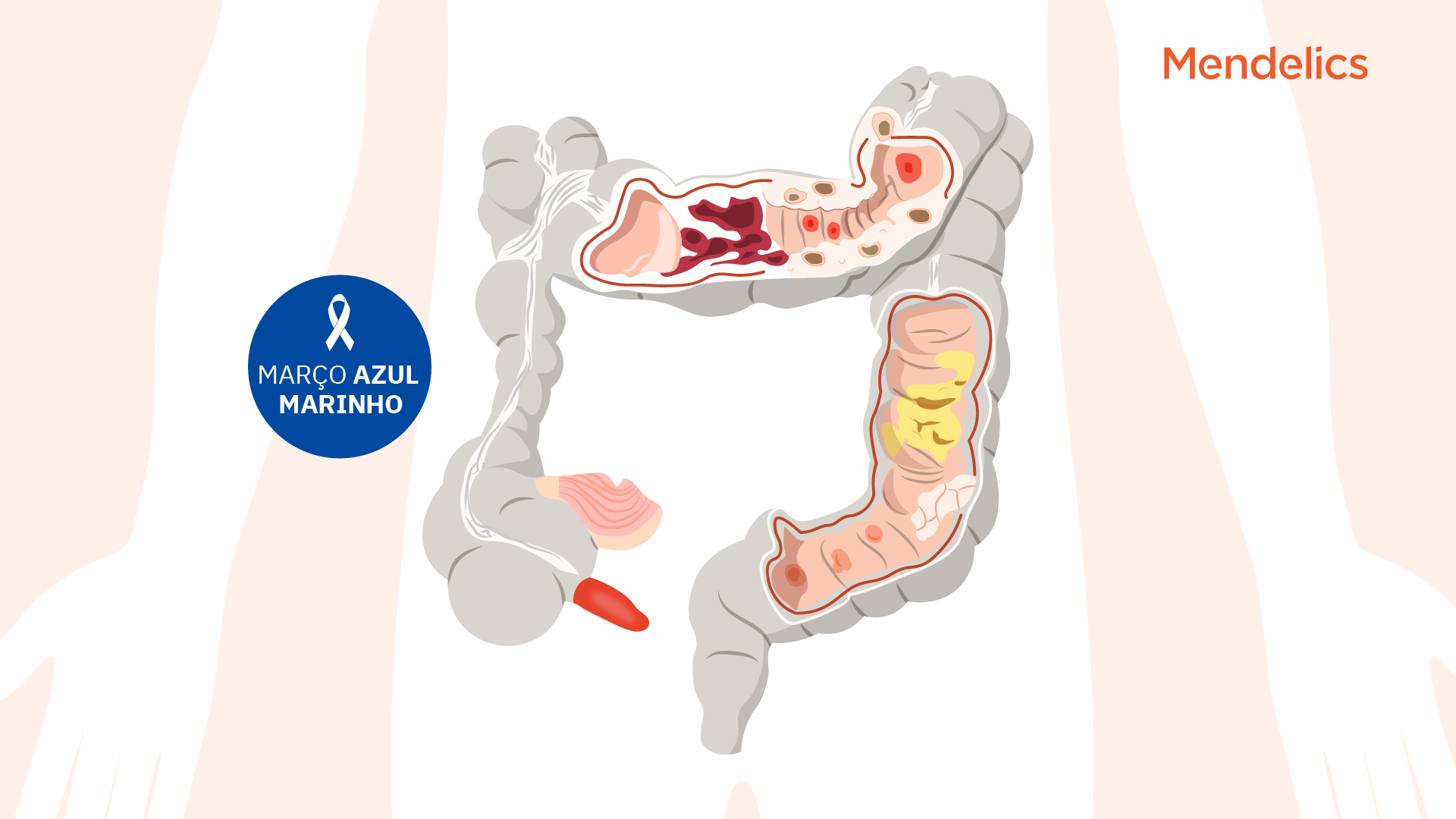 ilustração de um intestino grosso